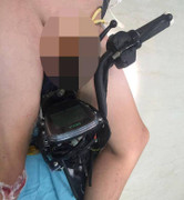 Bé trai bị tay lái xe đạp điện đâm qua vùng bẹn