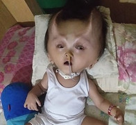 Video: Bé trai 22 tháng tuổi 'mọc sừng' vì căn bệnh hiếm gặp