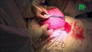 Video: Cắt bỏ khối u khổng lồ, to bằng đứa trẻ trong tử cung