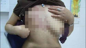 Clip: Tiêm filler nâng ngực tại spa, cô gái hoại tử một bên ngực