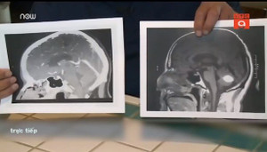 Kỳ diệu u não biến mất ngay trước ngày phẫu thuật