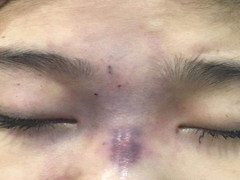 Video: Cô gái mù mắt sau khi bạn trai tiêm filler nâng mũi