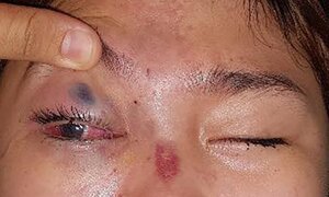 Clip: Được bạn trai tiêm filler tiêm nâng mũi, cô gái mù mắt