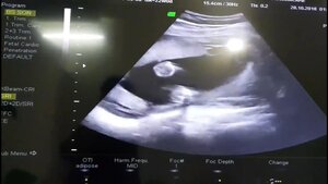 Thai nhi 5 tháng tuổi đã biết gãi đầu, ngáp ngủ cực dễ thương