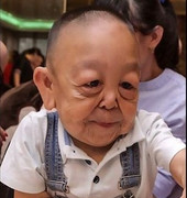 Hội chứng kỳ lạ khiến cậu bé 6 tuổi có khuôn mặt của cụ ông 90