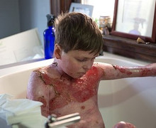 Căn bệnh quái gở khiến cậu bé 15 tuổi liên tục rách toạc da trong đau đớn