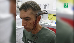 Bị dao đâm xuyên đầu vẫn tỉnh táo đạp xe đến bệnh viện, hỏi 'có bác sĩ nào rảnh không?'