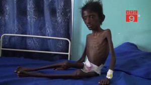 Bé trai Yemen gầy trơ xương, 5 tuổi chỉ nặng 8 kg khiến cả thế giới xót xa