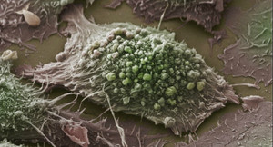 Các nhà khoa học tìm ra cách diệt ung thư trong vài giây