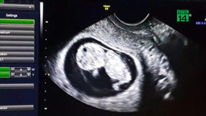 Em bé đầu tiên ra đời từ tử cung người chết được cấy ghép