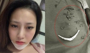 Gặp biến chứng khủng khiếp, cô gái trẻ phải tháo bỏ độn cằm