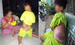 Mẹ bé trai khuyết tật bị giáo viên đánh bầm tím: 'Do cô thương cháu quá'