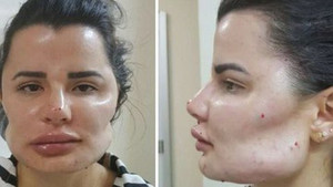 Bác sĩ thẩm mỹ khiến hàng chục bệnh nhân biến dạng mặt, không thể phục hồi