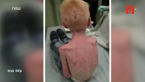 Mẹ kế tàn nhẫn ngược đãi, bỏ đói con chồng đến mức chỉ còn da bọc xương