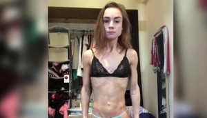 Cô gái nhai 15.000 miếng kẹo cao su để giảm cân và kết quả khiến ai cũng sốc