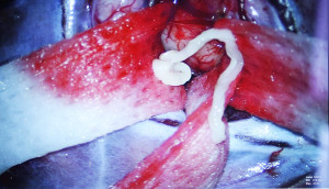 Người đàn ông 52 tuổi bị sán nhái tấn công não