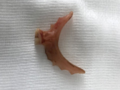 Lấy cung răng 35mm trong thực quản người phụ nữ