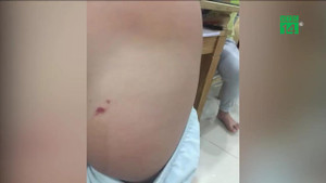Bé trai 4 tuổi ở Hà Nội nghi bị cô giáo cấu chảy máu vùng kín