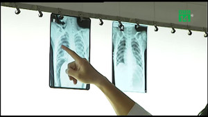 Bị bơm hơi vào hậu môn, bé trai Đồng Nai vỡ ruột già nguy kịch