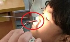 Uống nước suối, bé gái bị vắt khổng lồ ký sinh trong hốc mũi