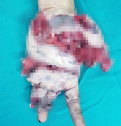 Bình gas phát nổ khi đang ăn lẩu, nam thanh niên nát bàn tay