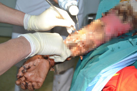 Đắp thuốc nam chữa bỏng, người phụ nữ suýt hoại tử cánh tay