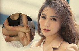 Hương Tràm bị dị ứng cấp tính nặng, toàn thân nổi mẩn đỏ