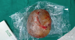 Bé trai 4 tháng tuổi phình to bụng vì mang 'thai trong thai' hiếm gặp