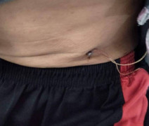 Cứu người thợ xây bị đinh đâm xuyên thành bụng