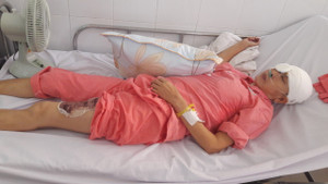 Ngã vào máy làm bún, người phụ nữ bị lóc toàn bộ da đầu