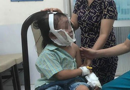 Dùng chai vuốt tóc xịt vào bếp than gây cháy, bé gái 6 tuổi bỏng nặng vùng mặt