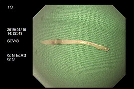 Người phụ nữ bị chảy mủ thực quản sau một tuần hóc xương gà