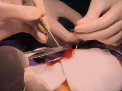 Hơn một giờ căng thẳng cứu bé trai hai ngày tuổi bị tắc ruột bẩm sinh