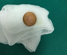 Đùa nghịch, bé gái 3 tuổi nuốt đồng xu vào họng