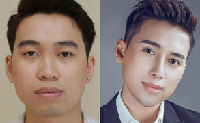 5 chàng trai ‘lột xác’ ngoạn mục sau phẫu thuật thẩm mỹ