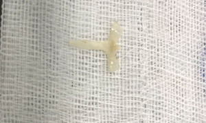 Xương ếch trong thực quản bé gái 10 tháng tuổi