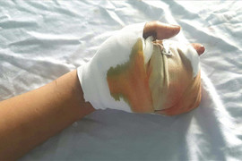 Nghịch pháo tự chế, thiếu niên 15 tuổi bị dập nát bàn tay