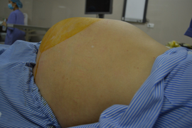 Tưởng béo bụng, đi khám mới biết có khối u khổng lồ