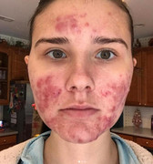 Mặt đầy mụn trứng cá, cô gái 23 tuổi không dám ra đường