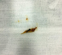 Mổ ruột thừa, bác sĩ phát hiện xương cá đâm thủng ruột non