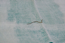 Cấp cứu nam thanh niên nuốt cả dây thép vào bụng khi ăn gà