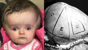 12 giờ căng thẳng phẫu thuật đầu to bất thường cho bé gái 2 tuổi