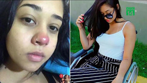 Xỏ khuyên mũi bị nhiễm trùng, thiếu nữ xinh đẹp liệt 2 chân