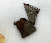 Người đàn ông 57 tuổi bị lưỡi cưa gạch bắn vào mắt