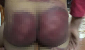 Bố có hai tiền án hành hung con gái thâm tím cơ thể