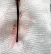 Gắp con đỉa còn sống dài 4cm ra khỏi mũi cô gái ở Quảng Nam