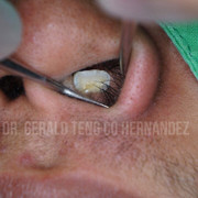 Kỳ lạ: Người đàn ông có răng 'mọc' trong mũi