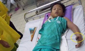 Ra ruộng bắt cua cùng bố, bé trai 11 tuổi bị rắn hổ mang cắn