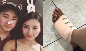 Đi chơi 8/3, Phan Mạnh Quỳnh và bạn gái gặp tai nạn xe phải khâu 20 mũi