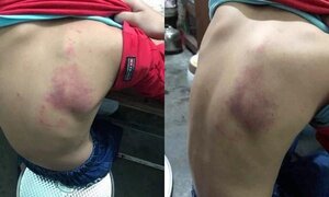 Video: Học sinh lớp 2 bị cô đánh bầm lưng vì không làm đúng bài tập